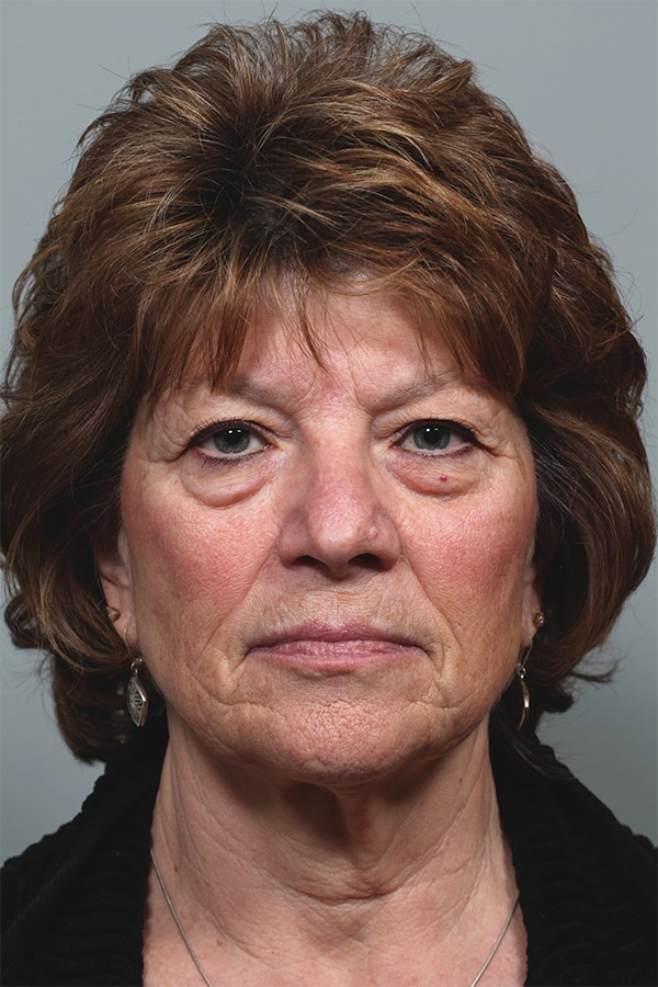 Before Image: Upper and Lower Blepharoplasty - front
