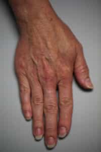 Restylane Lyft to Hands