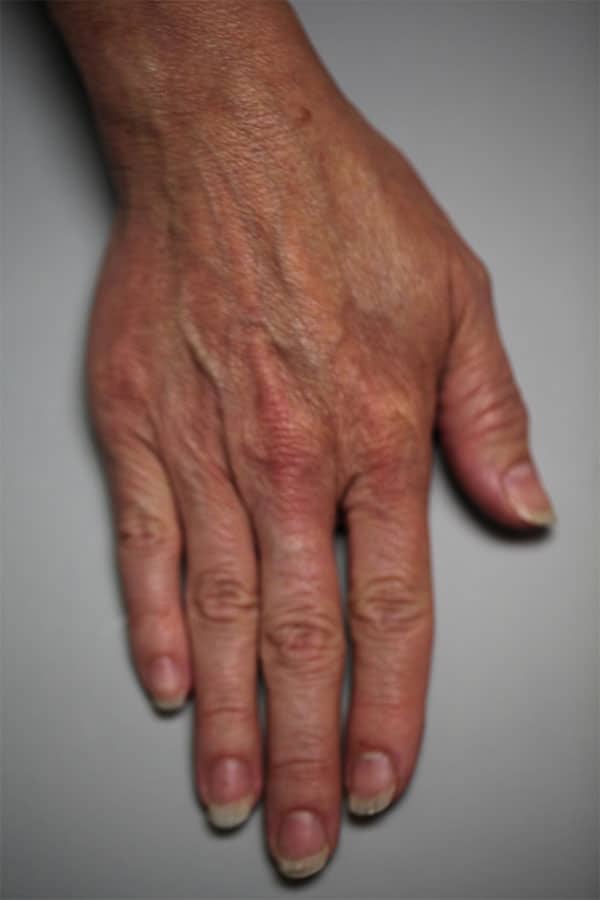 Before Image: Restylane Lyft to Hands - front