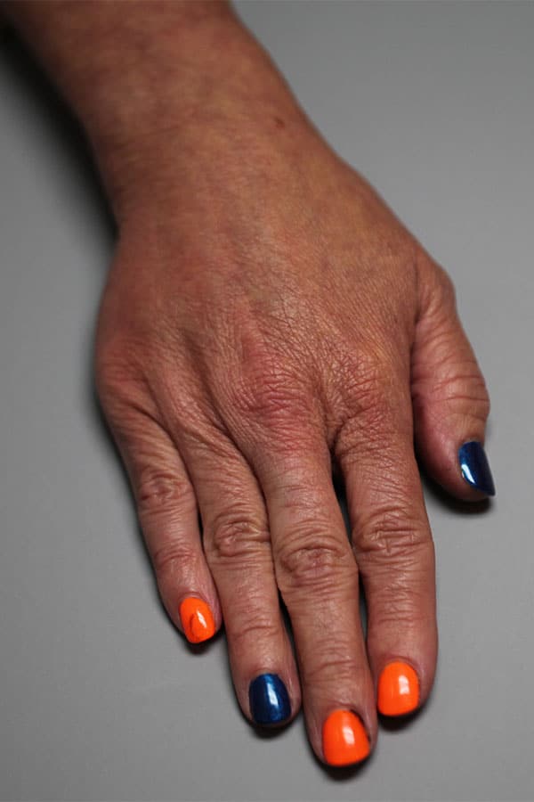 After Image: Restylane Lyft to Hands - front