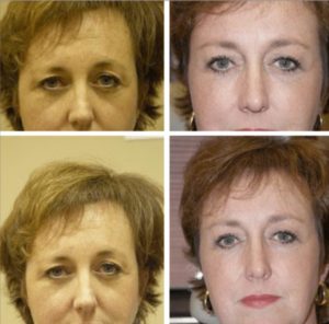 brow lift