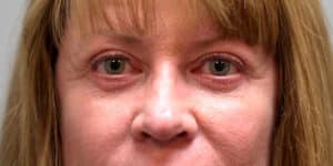 Upper and Lower Blepharoplasty