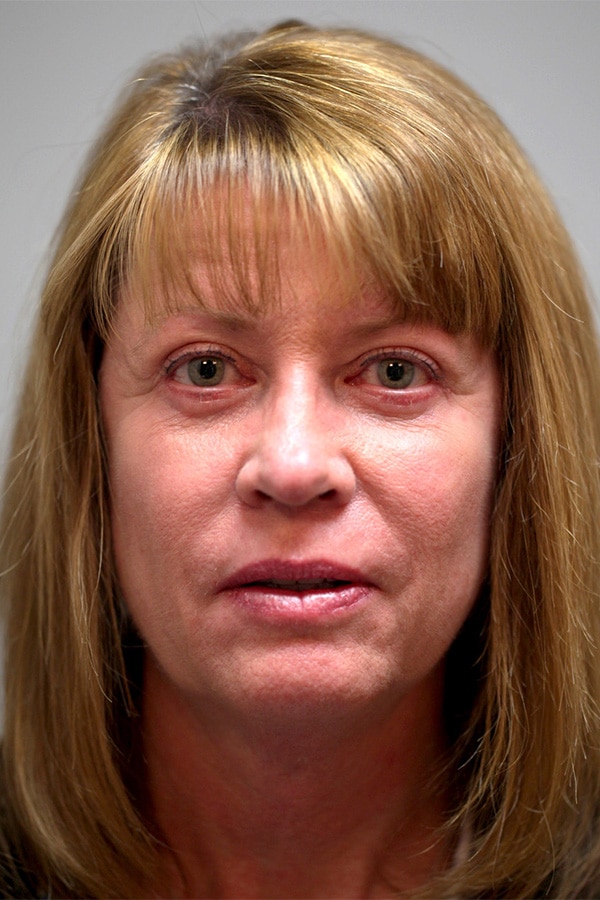 After Image: Upper and Lower Blepharoplasty - front