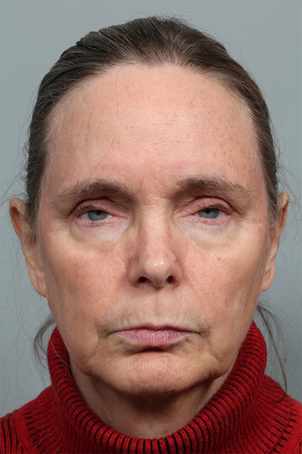 Before Image: Upper Blepharoplasty and Ptosis Repair - front