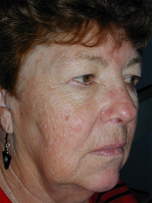 Before Image: Upper & Lower Blepharoplasty, Facelift, Necklift and Full Face Laser Resurfacing - right-front-oblique