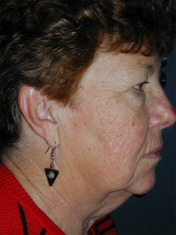 Before Image: Upper & Lower Blepharoplasty, Facelift, Necklift and Full Face Laser Resurfacing - right-side