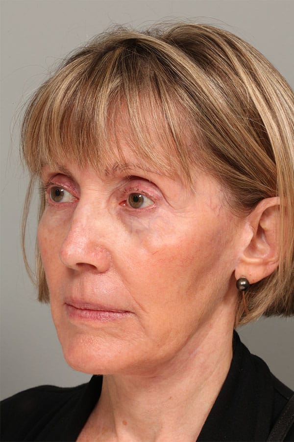 After Image: Jowl & Necklift and Lower Blepharoplasty - left-front-oblique