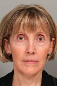 Jowl & Necklift and Lower Blepharoplasty