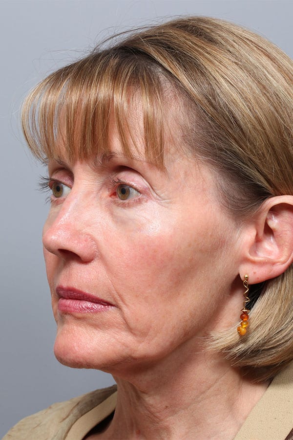 Before Image: Jowl & Necklift and Lower Blepharoplasty - left-front-oblique