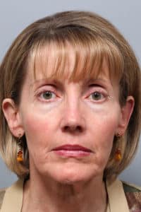 Jowl & Necklift and Lower Blepharoplasty