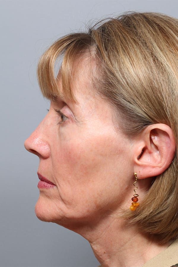 Before Image: Jowl & Necklift and Lower Blepharoplasty - left-side