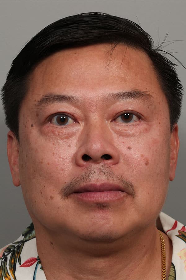 After Image: Upper Asian Blepharoplasty and Lower Blepharoplasty - front