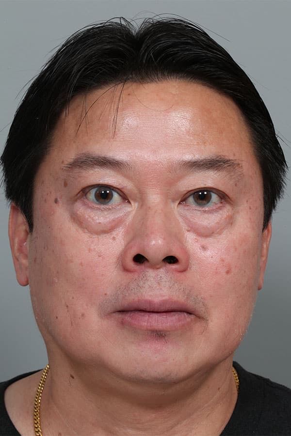 Before Image: Upper Asian Blepharoplasty and Lower Blepharoplasty - front