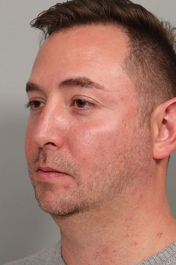 After Image: Allura Laser Assisted Lipo to Neck and Chin Implant - left-front-oblique