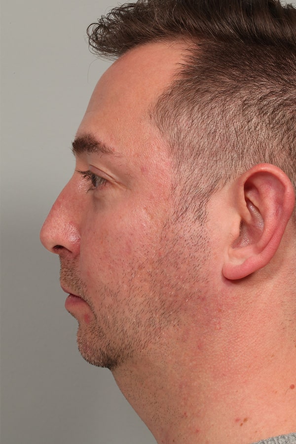 After Image: Allura Laser Assisted Lipo to Neck and Chin Implant - left-side