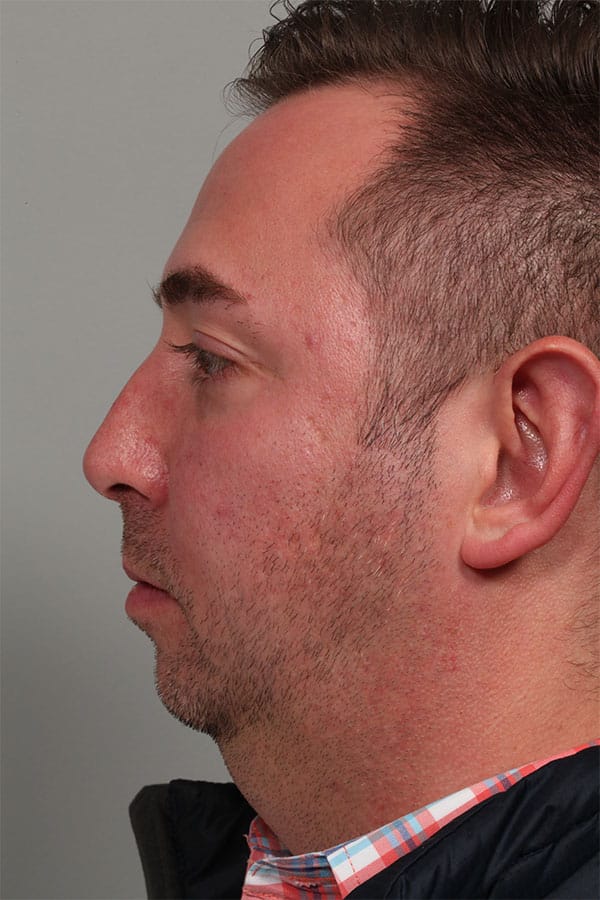 Before Image: Allura Laser Assisted Lipo to Neck and Chin Implant - left-side