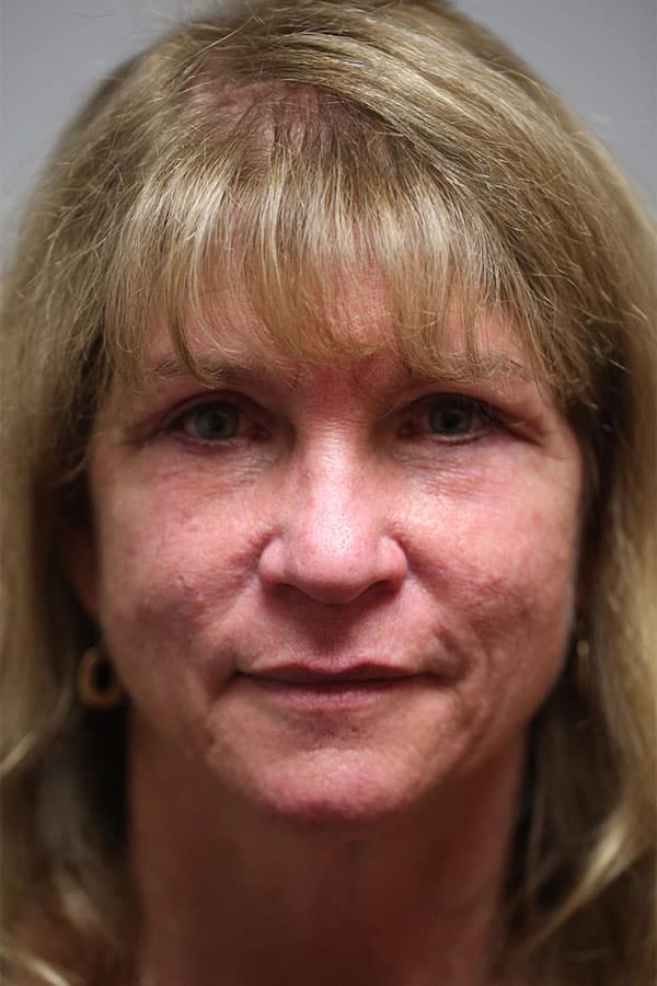 After Image: Upper & Lower Blepharoplasty - front
