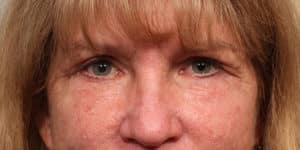 Upper & Lower Blepharoplasty