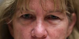 Upper & Lower Blepharoplasty