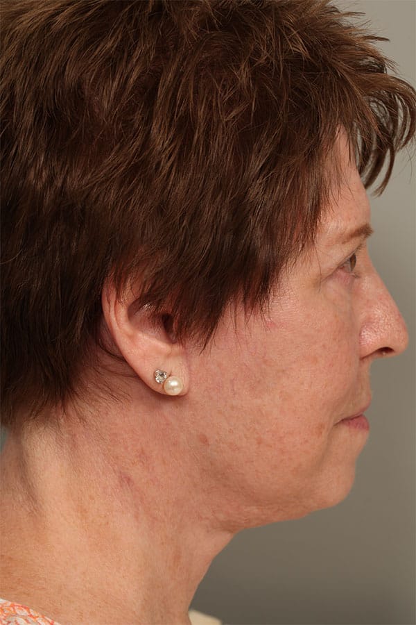 After Image: Facelift and Necklift - front