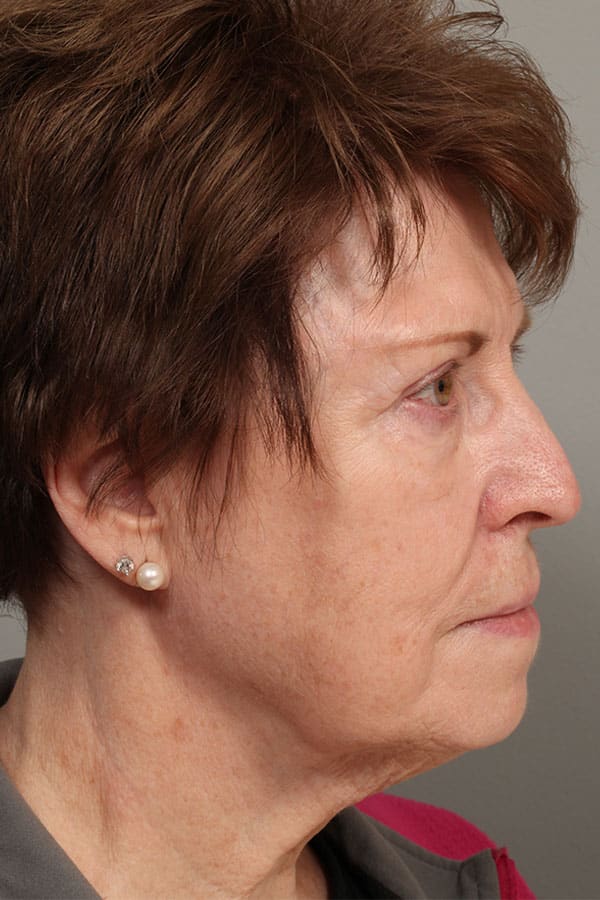 Before Image: Facelift and Necklift - front