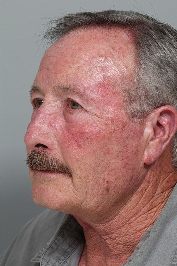 After Image: Midline Neck Suspension - left-front-oblique