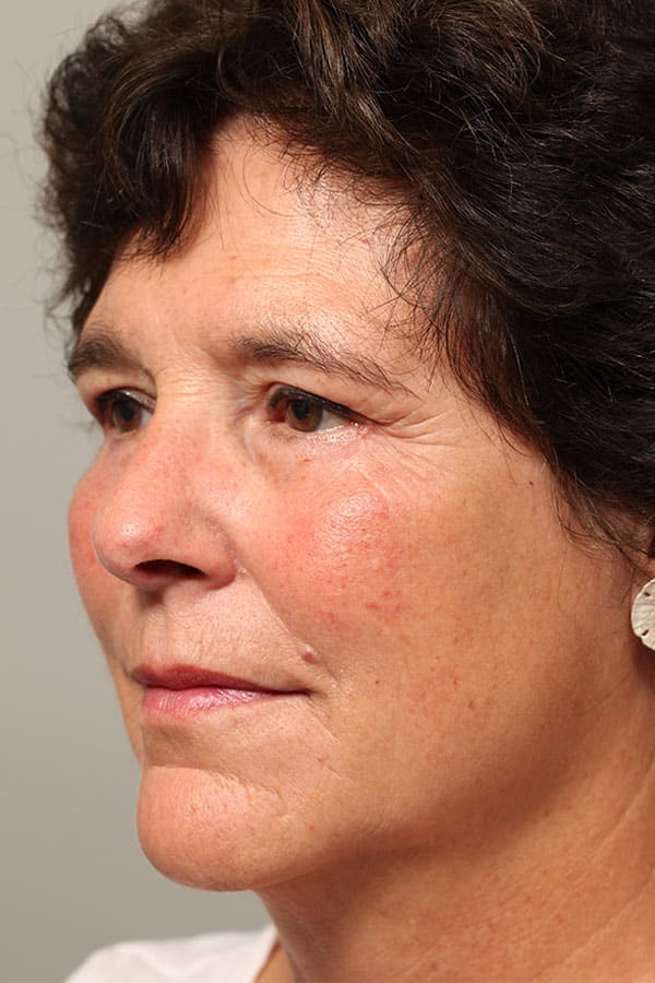 After Image: Upper & Lower Blepharoplasty, Endoscopic Mid Facelift - left-front-oblique