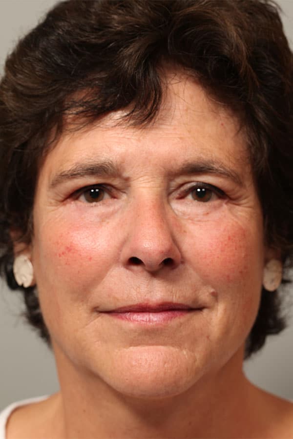 After Image: Upper & Lower Blepharoplasty, Endoscopic Mid Facelift - front