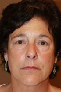 Upper & Lower Blepharoplasty, Endoscopic Mid Facelift