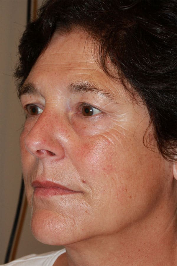 Before Image: Upper & Lower Blepharoplasty, Endoscopic Mid Facelift - left-front-oblique