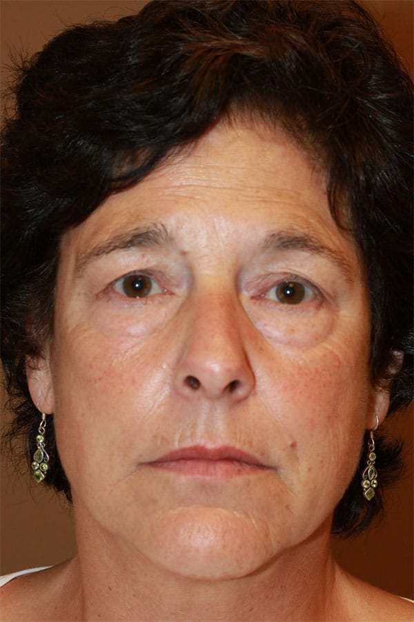 Before Image: Upper & Lower Blepharoplasty, Endoscopic Mid Facelift - front