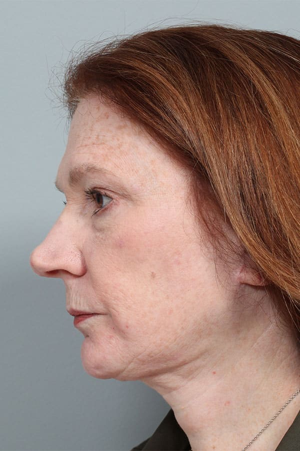 After Image: Jowl & Necklift with Liposuction - left-side