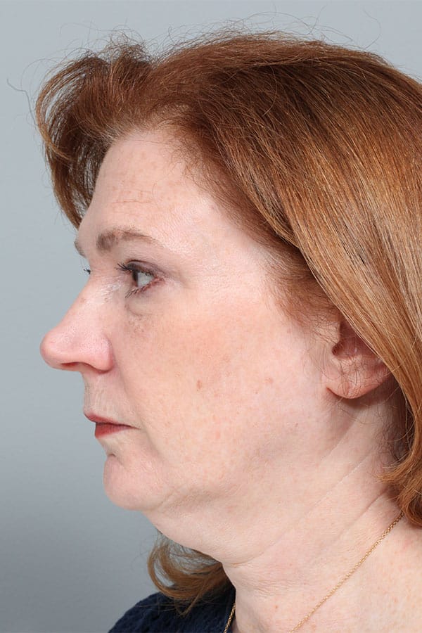 Before Image: Jowl & Necklift with Liposuction - left-side