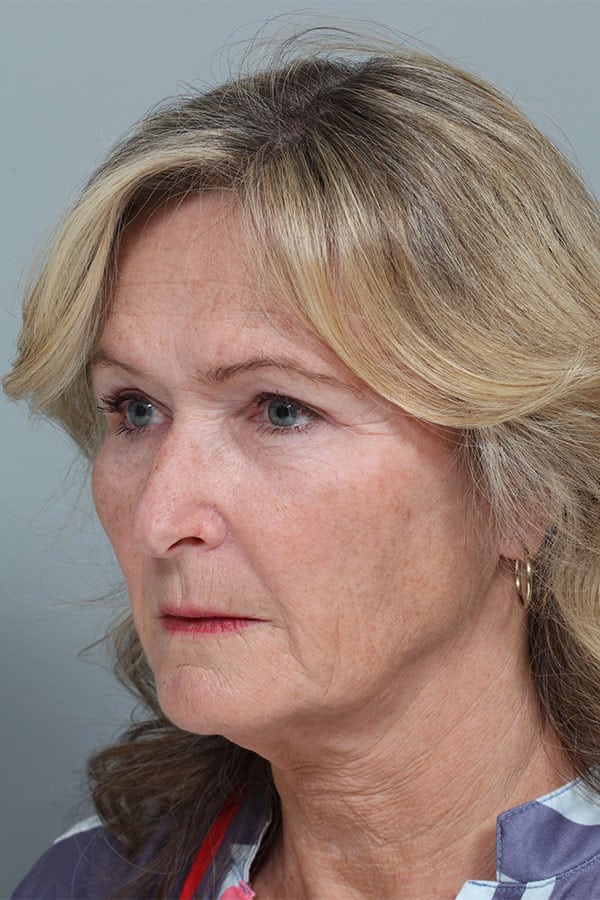 After Image: Endoscopic Mid-Facelift and Upper & Lower Blepharoplasty - left-front-oblique