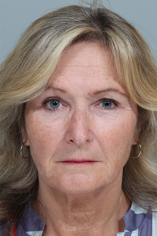 Endoscopic Mid-Facelift and Upper & Lower Blepharoplasty