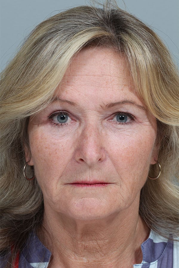 After Image: Endoscopic Mid-Facelift and Upper & Lower Blepharoplasty - front