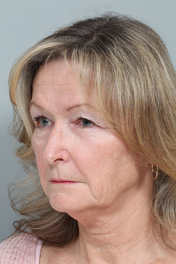 Before Image: Endoscopic Mid-Facelift and Upper & Lower Blepharoplasty - left-front-oblique