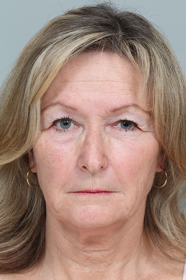 Before Image: Endoscopic Mid-Facelift and Upper & Lower Blepharoplasty - front