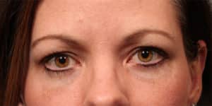 Lower Blepharoplasty