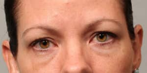 Lower Blepharoplasty