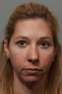 Lower Blepharoplasty