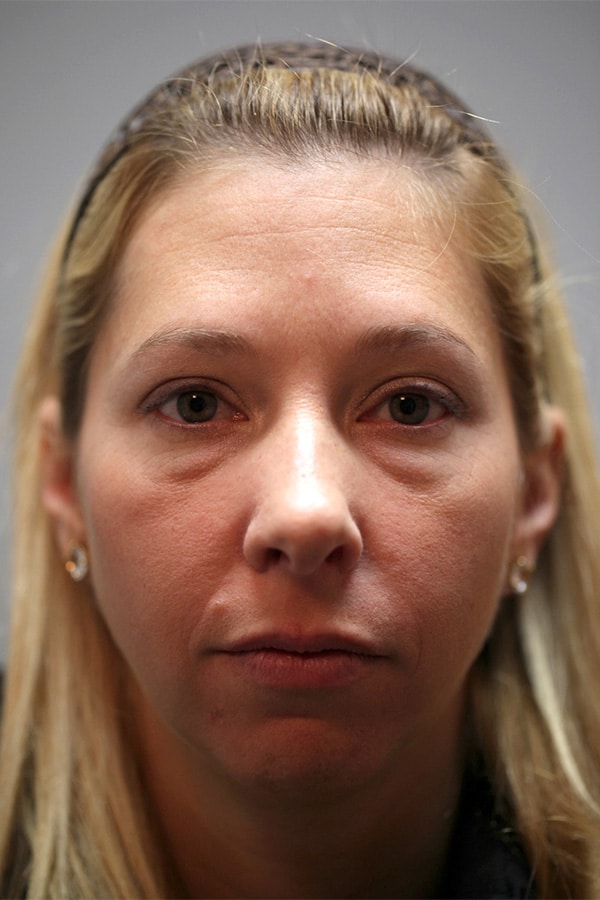 Before Image: Lower Blepharoplasty - front