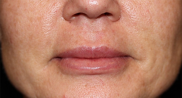 After Image: Lip Fillers - front