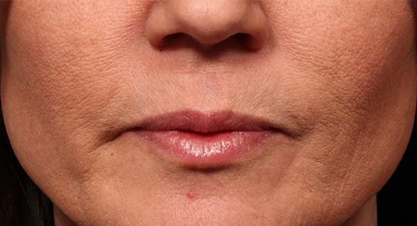 Before Image: Lip Fillers - front
