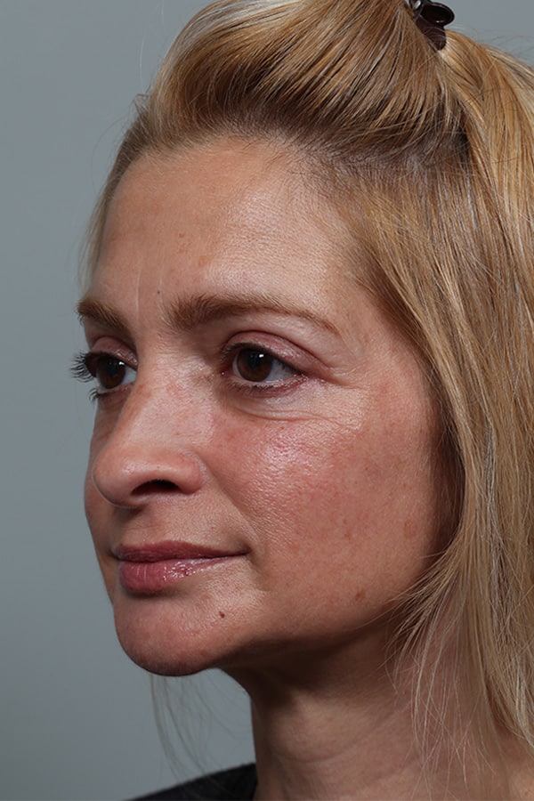 After Image: Upper and Lower Blepharoplasty - left-front-oblique