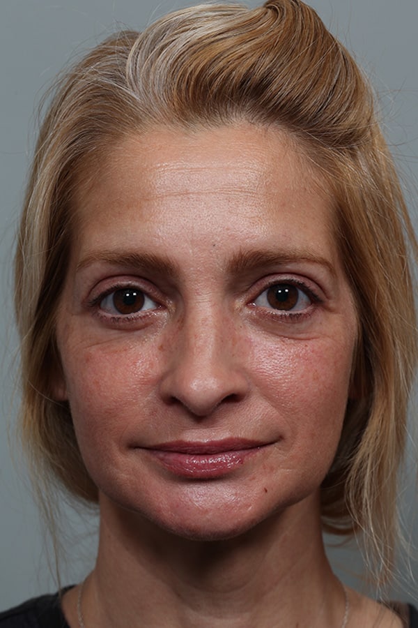 After Image: Upper and Lower Blepharoplasty - front