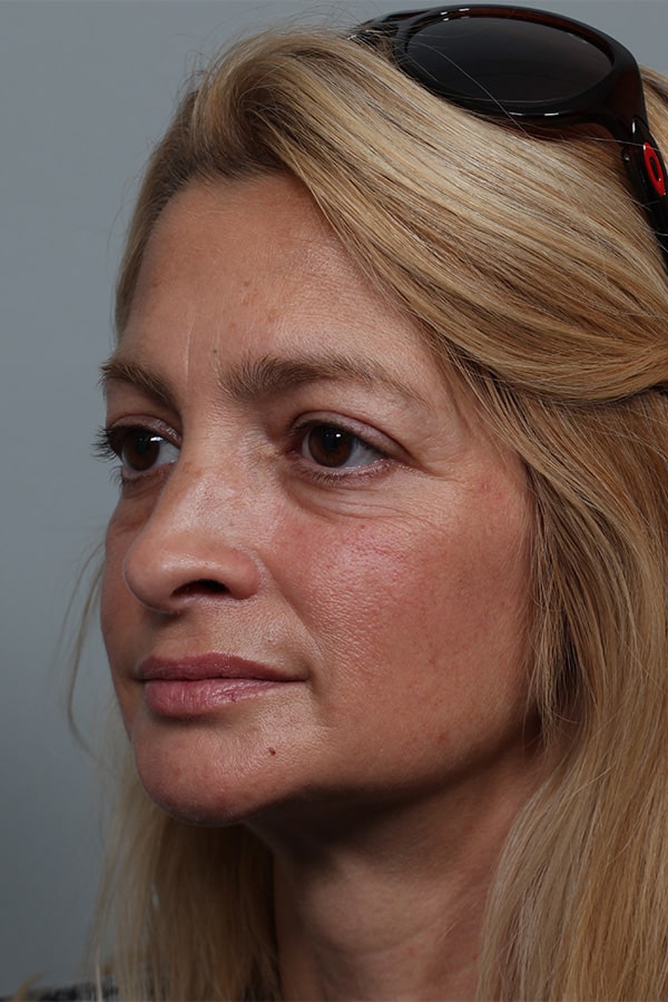 Before Image: Upper and Lower Blepharoplasty - left-front-oblique