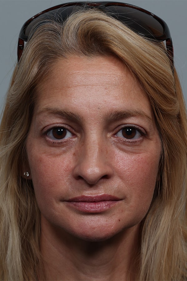Before Image: Upper and Lower Blepharoplasty - front