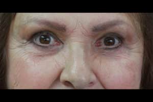 Upper and Lower Blepharoplasty