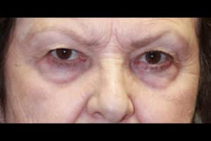 Upper and Lower Blepharoplasty